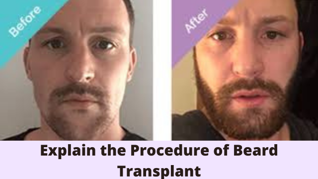Explain the Procedure of Beard Transplant