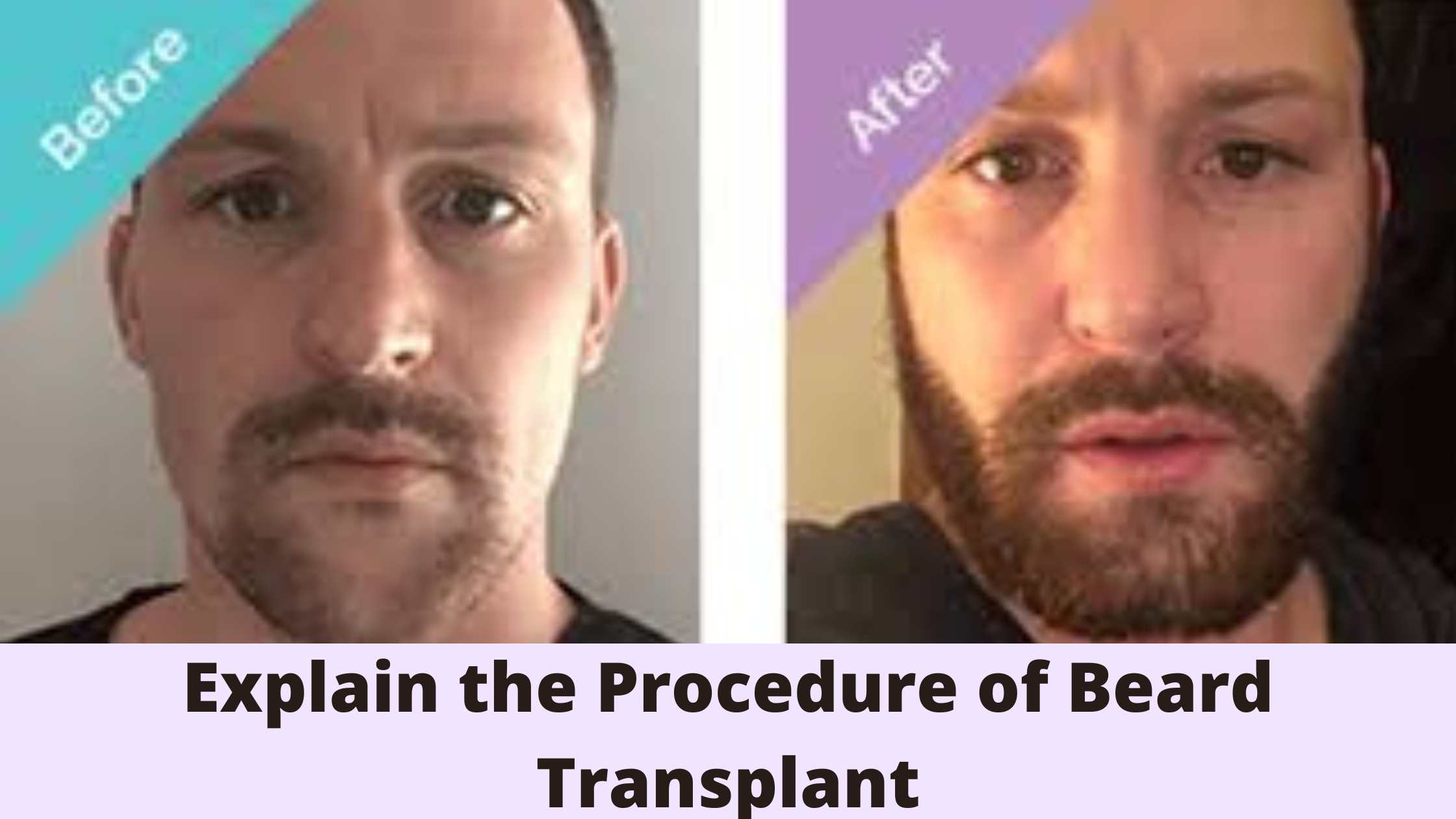 Beard Transplant