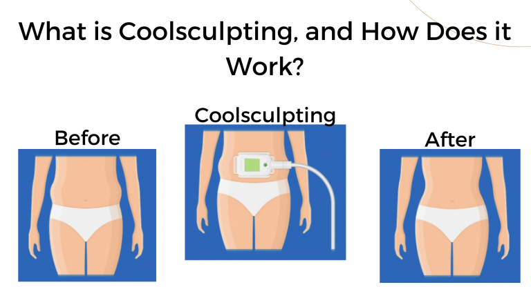 What is Coolsculpting, and How Does it Work?