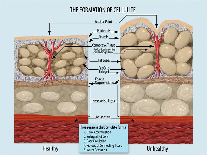 Pros of getting a cellulite reduction treatment