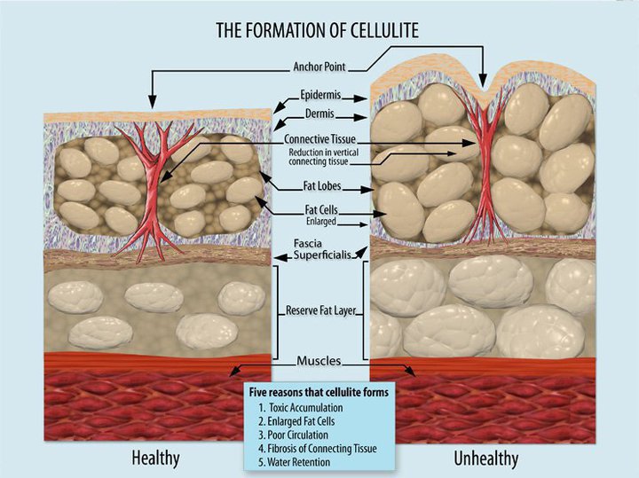 Cellulite Reduction Treatment